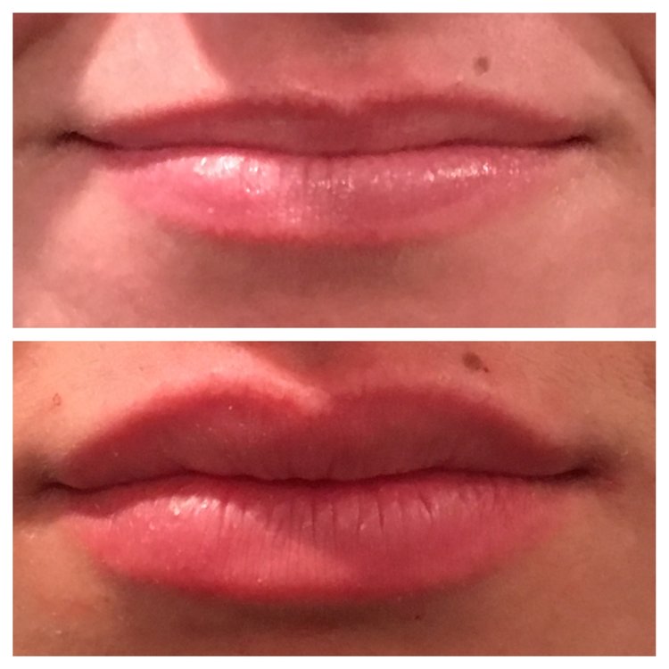 How to salvage a bad lip job (or avoid one in the first place
