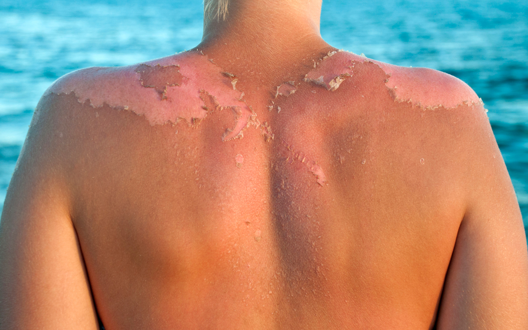 The Top Skin Problems Caused by the Sun (and What You Can Do About Them)