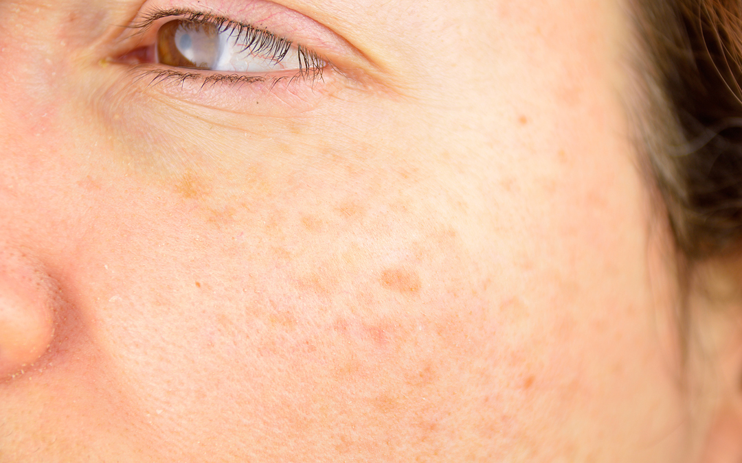 Got Sun Spots? Here’s What They Are and How to Fix Them