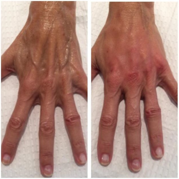 Hand rejuvenation before and after