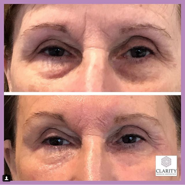 Eye rejuvenation before and after