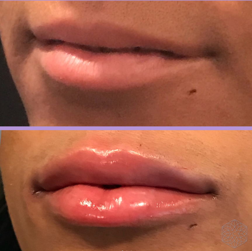 lip rejuvenation before and after