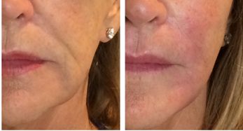 jowls before and after
