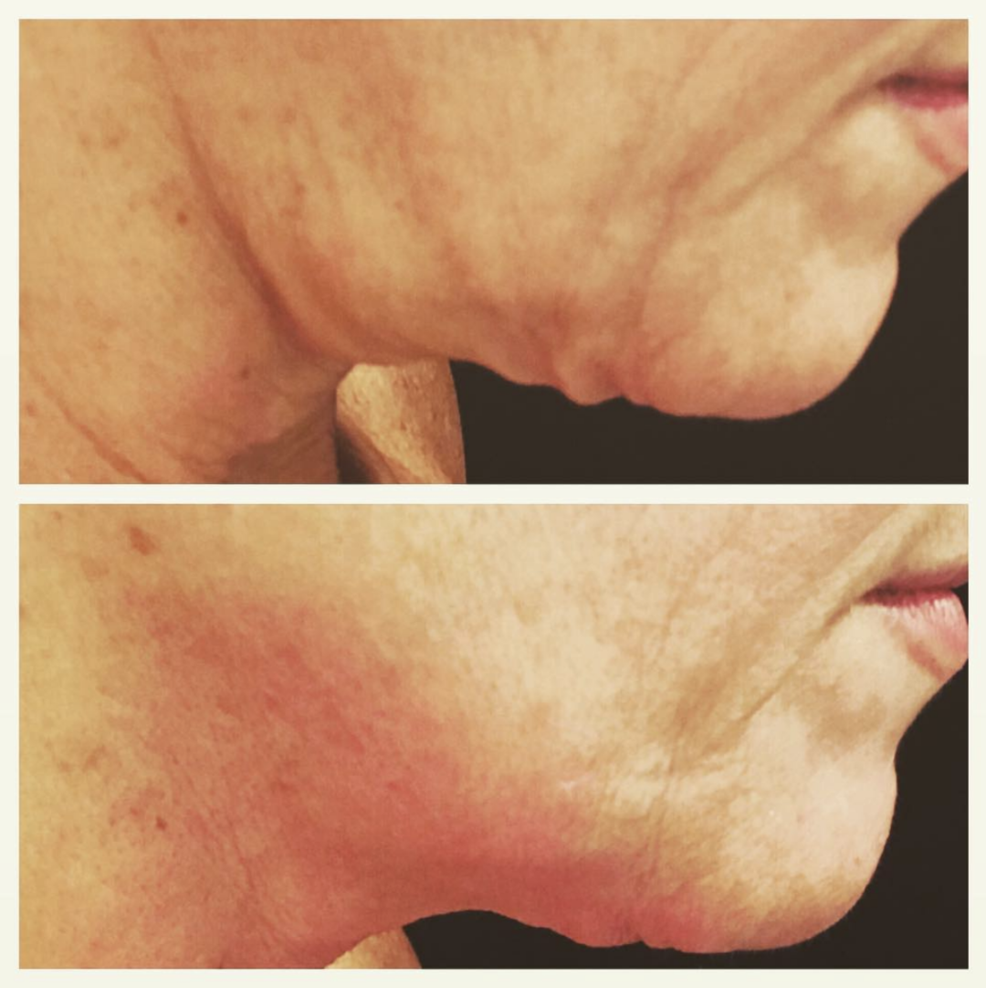 The Best Radio Frequency Treatments For Skin Tightening Clarity Medical Aesthetics