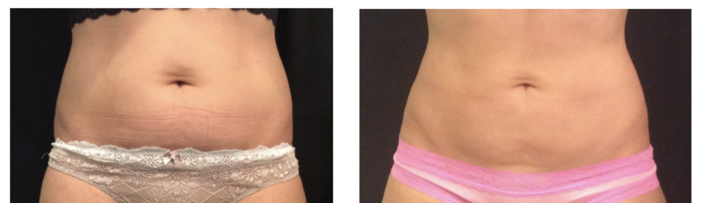 Abdomen before and after
