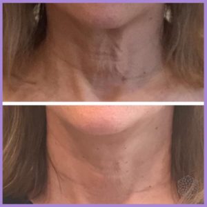 BOTOX neck bands before and after