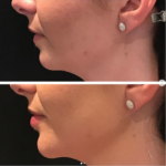 Clarity dermal fillers before and after chin