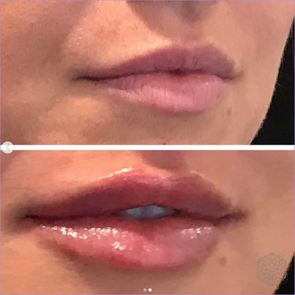 Clarity lip filler before and after