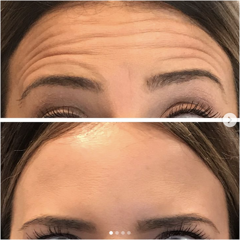 BOTOX before and after