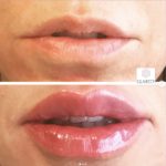 Restylane used on lips