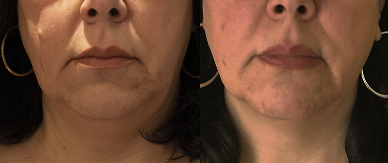 middle-aged women shows the front of her face in a before & after photo. the women has a sagging neck in the before photo and a lifted neck in the after photo 3 months after having the Morpheus8 treatment