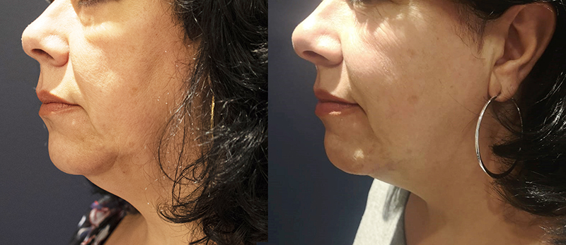 middle-aged women shows a before & after picture of the side profile of her face & it reveals a sagging chin in the before photo and a lifted chin in the after photo 3 months after having the Morpheus8 treatment