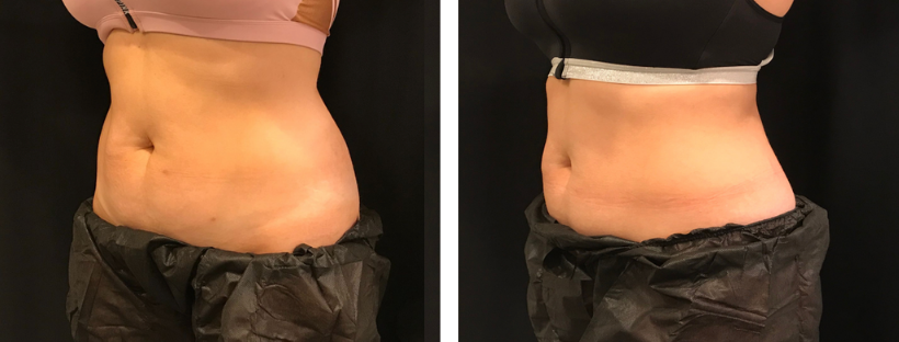 CoolSculpting muffin top before and after