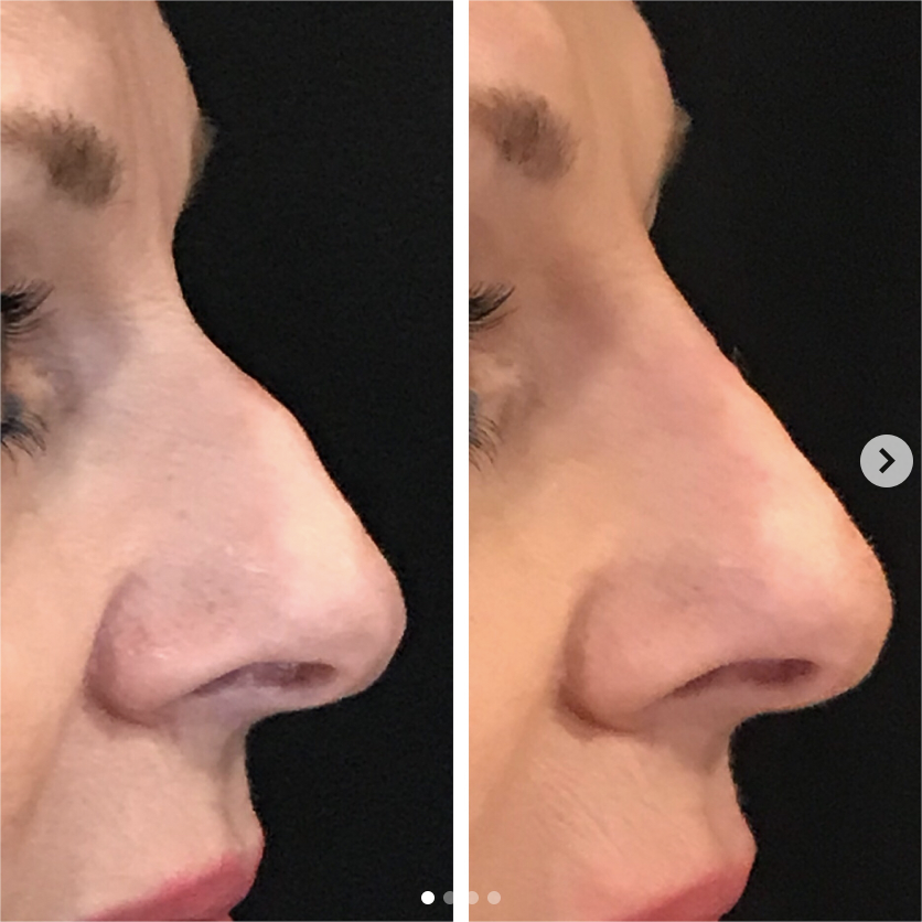 Non-surgical nose job before and after