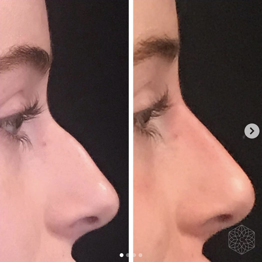 Non-surgical nose job before and after