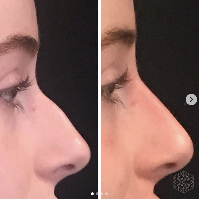 How To Get A Nose Job Without Anyone Knowing