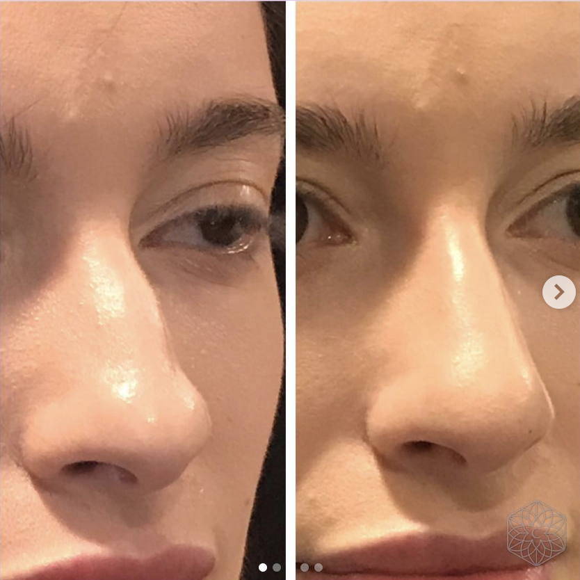 Non-surgical nose job before and after