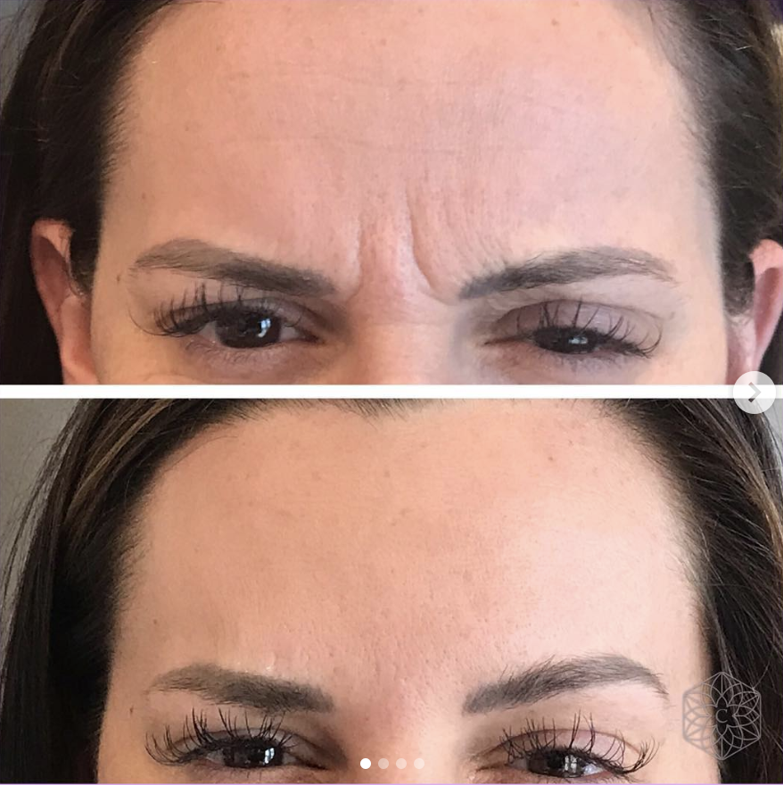 BOTOX before and after