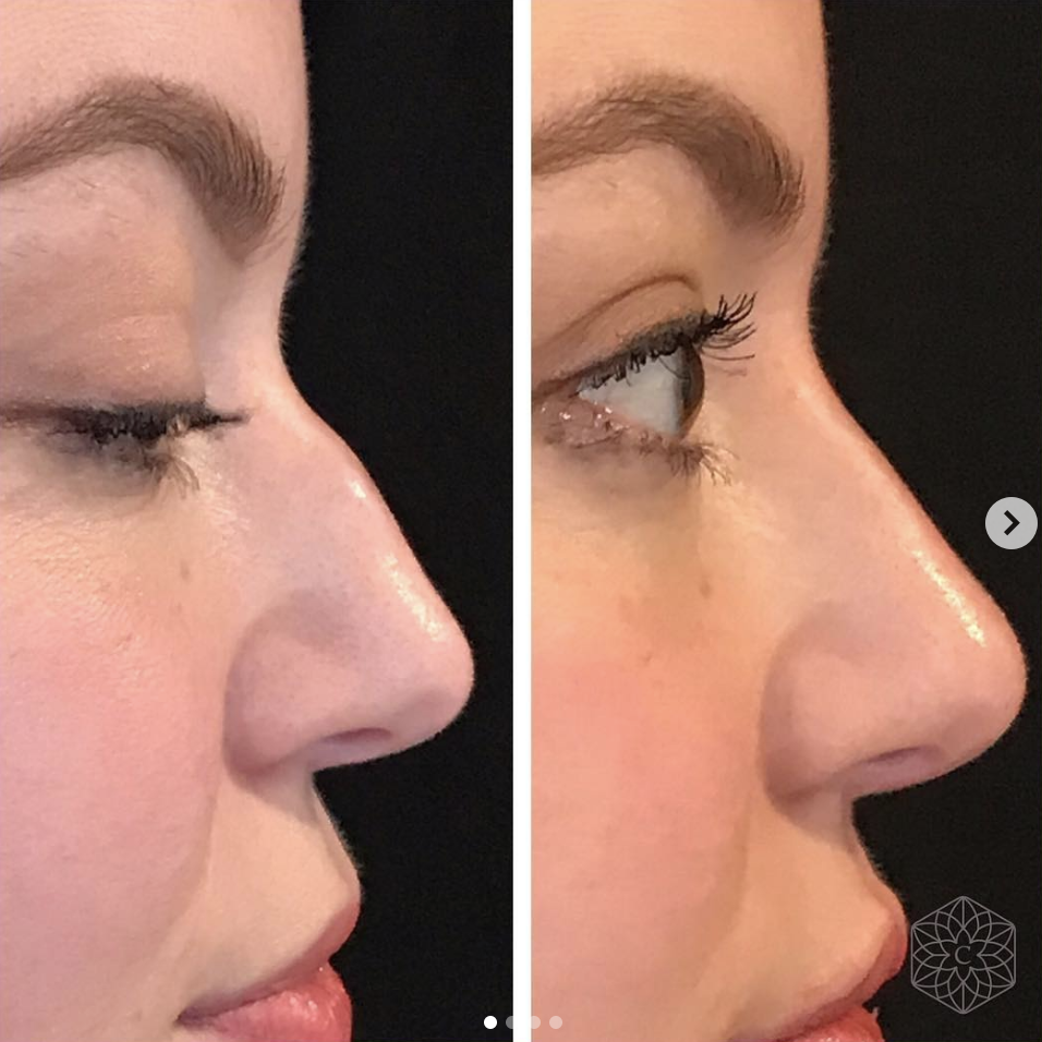 liquid nose job before and after