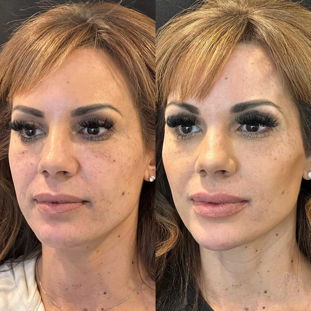 Dermal Fillers before and after