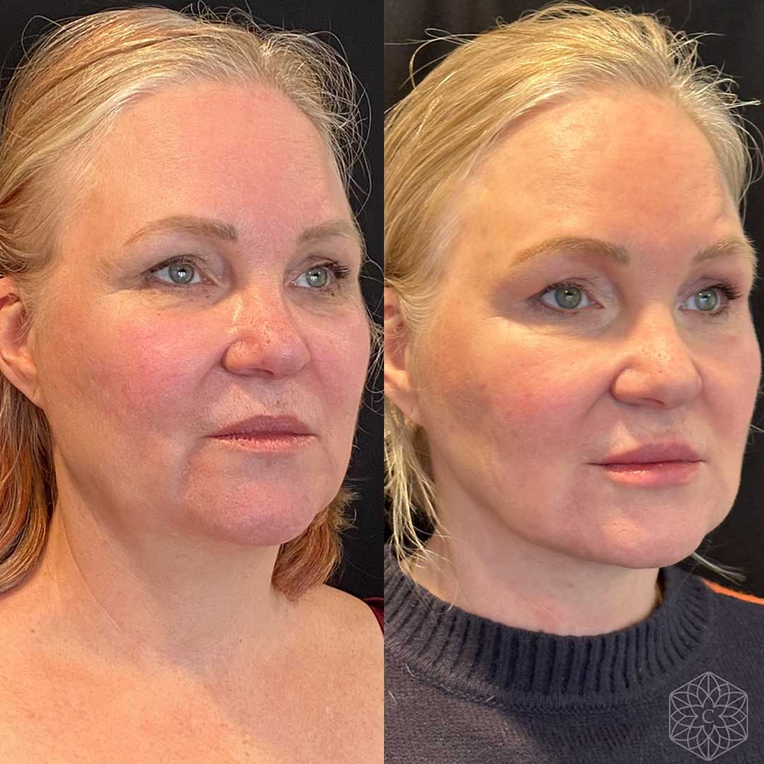 FaceTite before and after