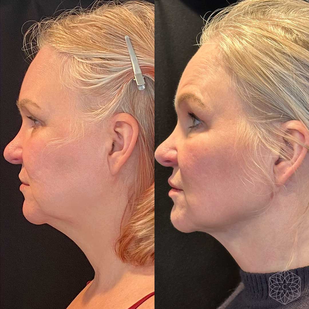 FaceTite before and after