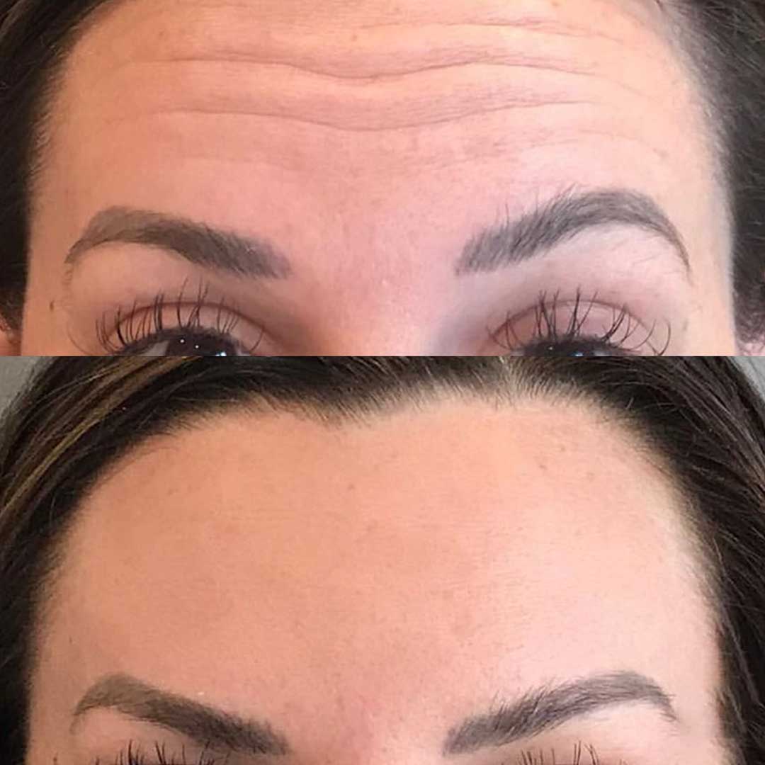 Before and after toxin smooth forehead