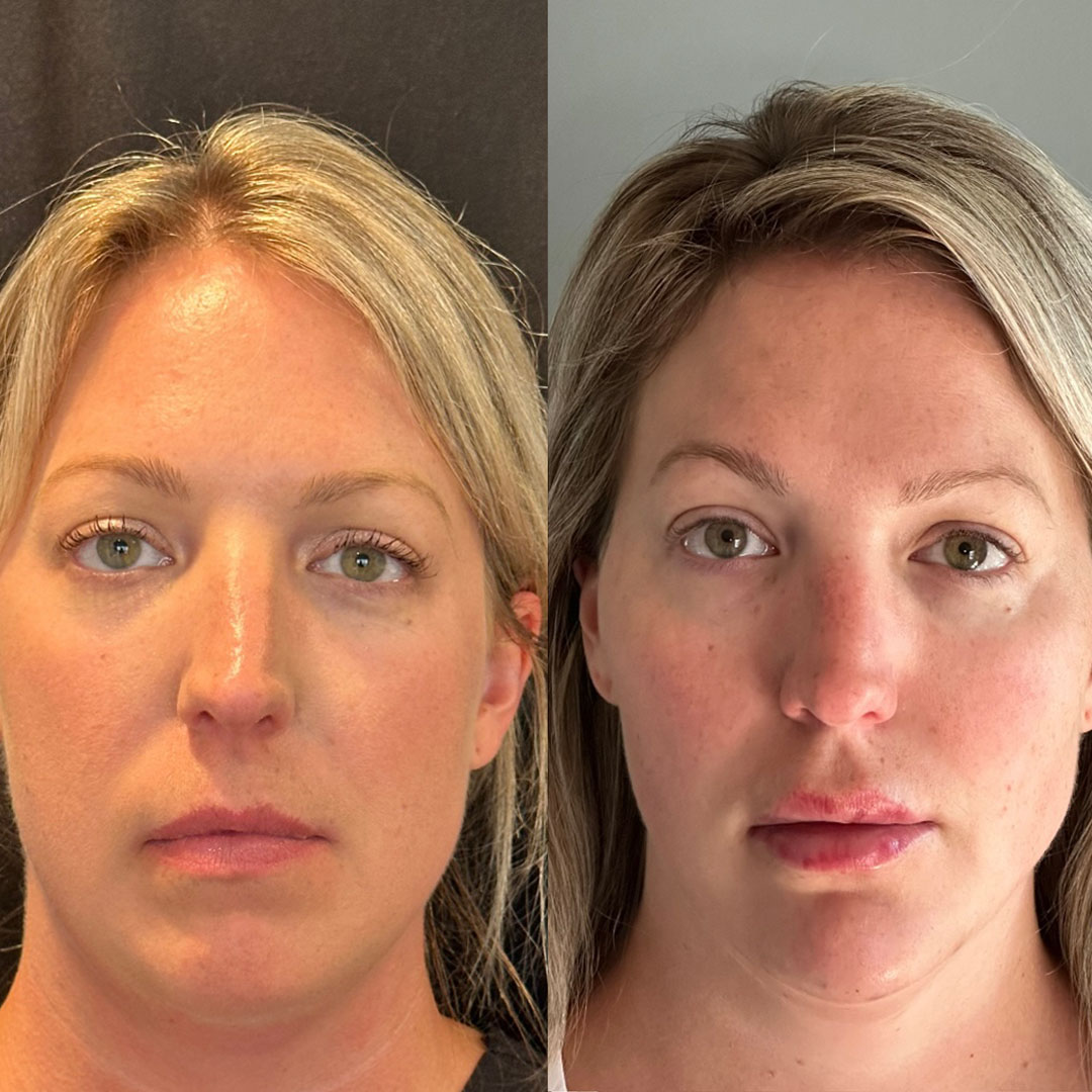 Before and after Kybella treatment