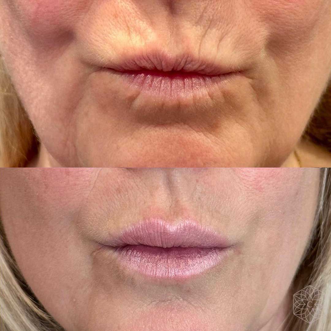 Relaxed vertical lip lines