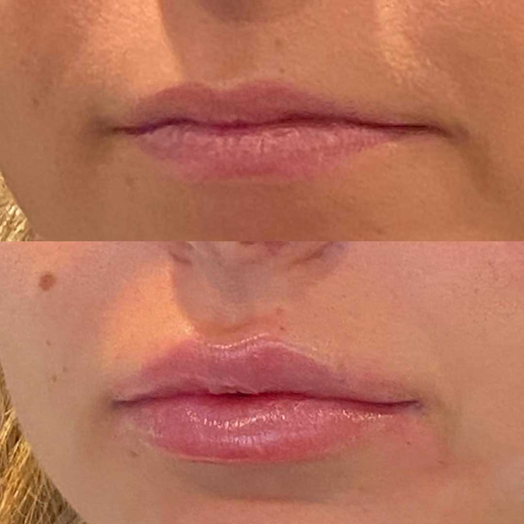 Lip Rejuvenation before and after