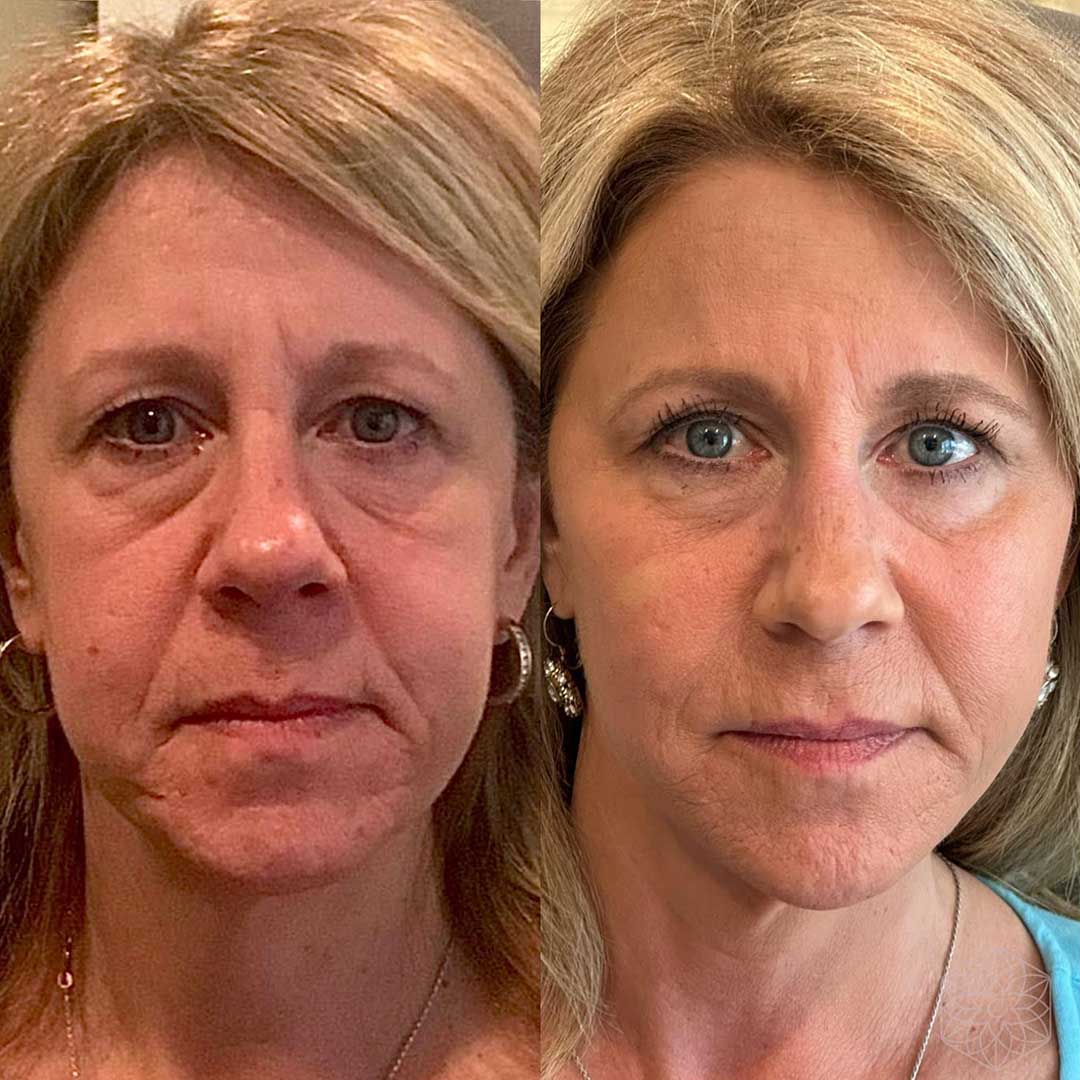 Before and after of a liquid face lift