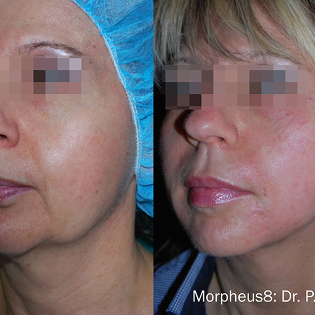Before and after morpheus8 treatment