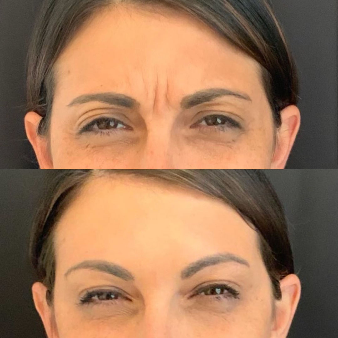 Tox placed between eyebrows to prevent creases