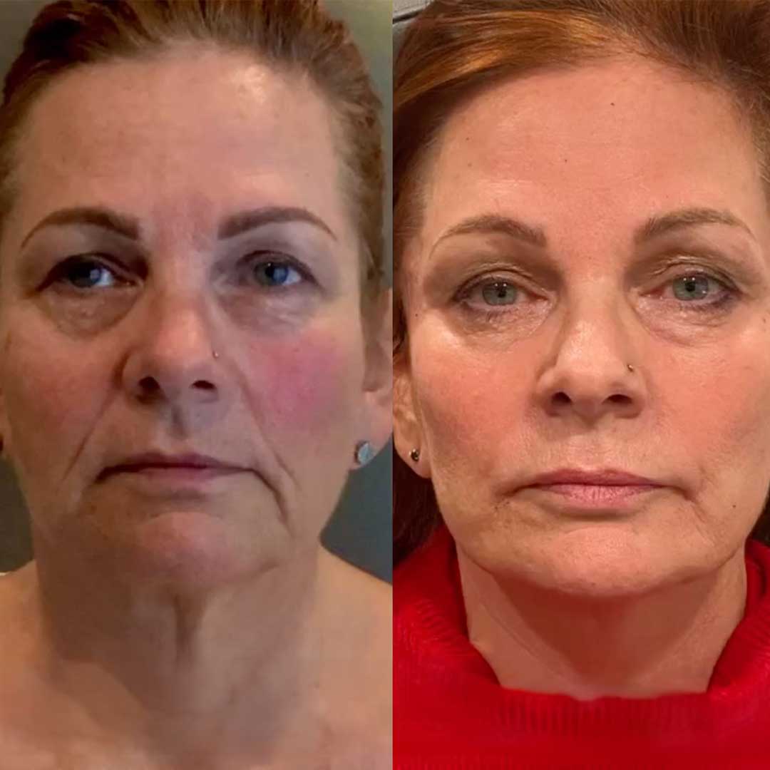 Before and After of a long-term Clarity Patient