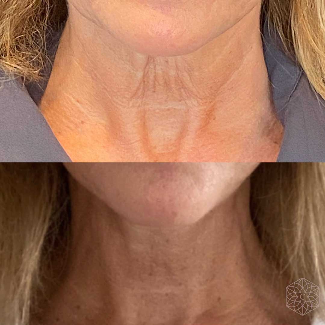 Before and after neck rejuvenation with PDO threads