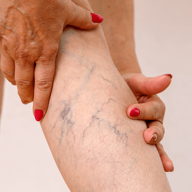 Close up of spider veins on back of leg