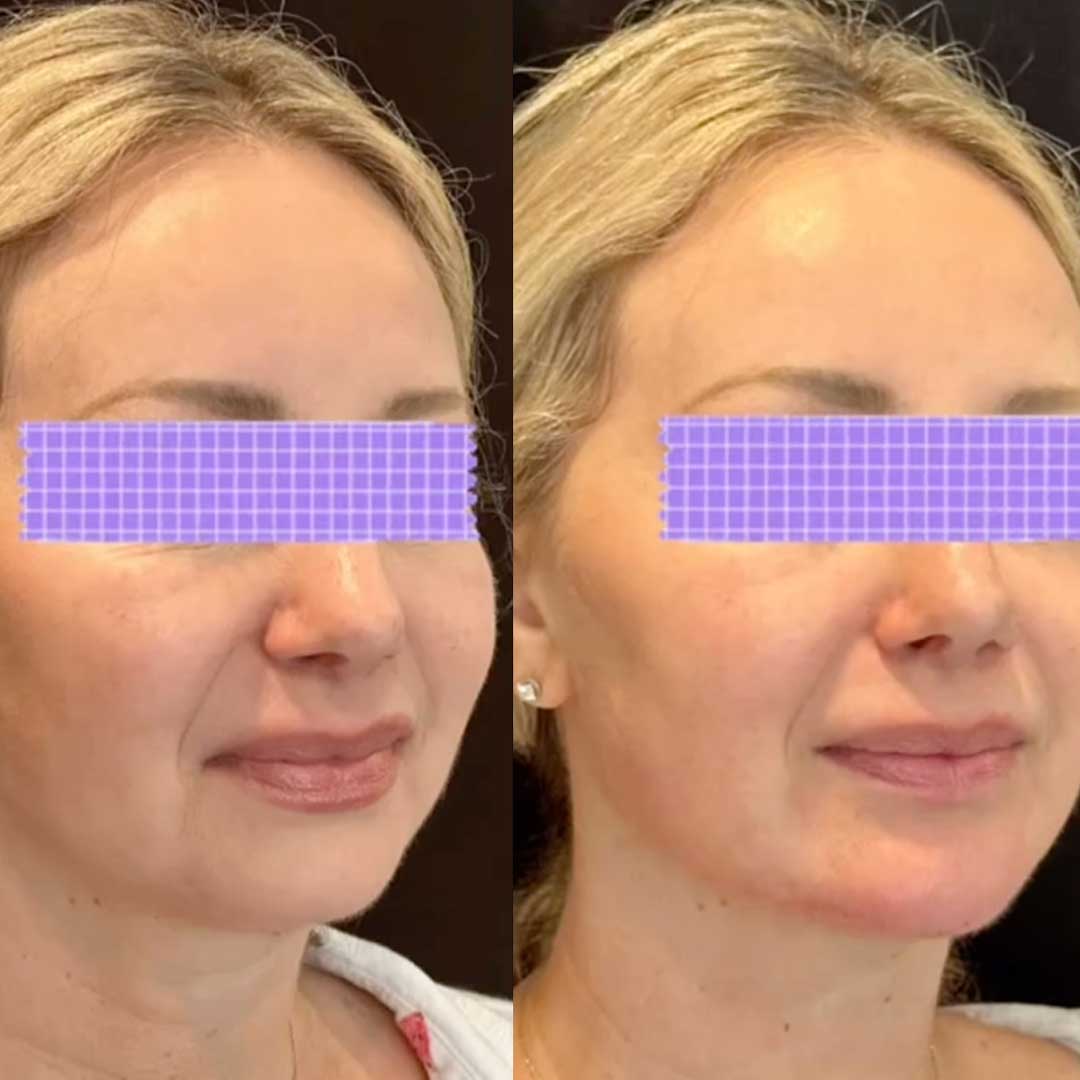Woman with contoured jawline after clarity treatment