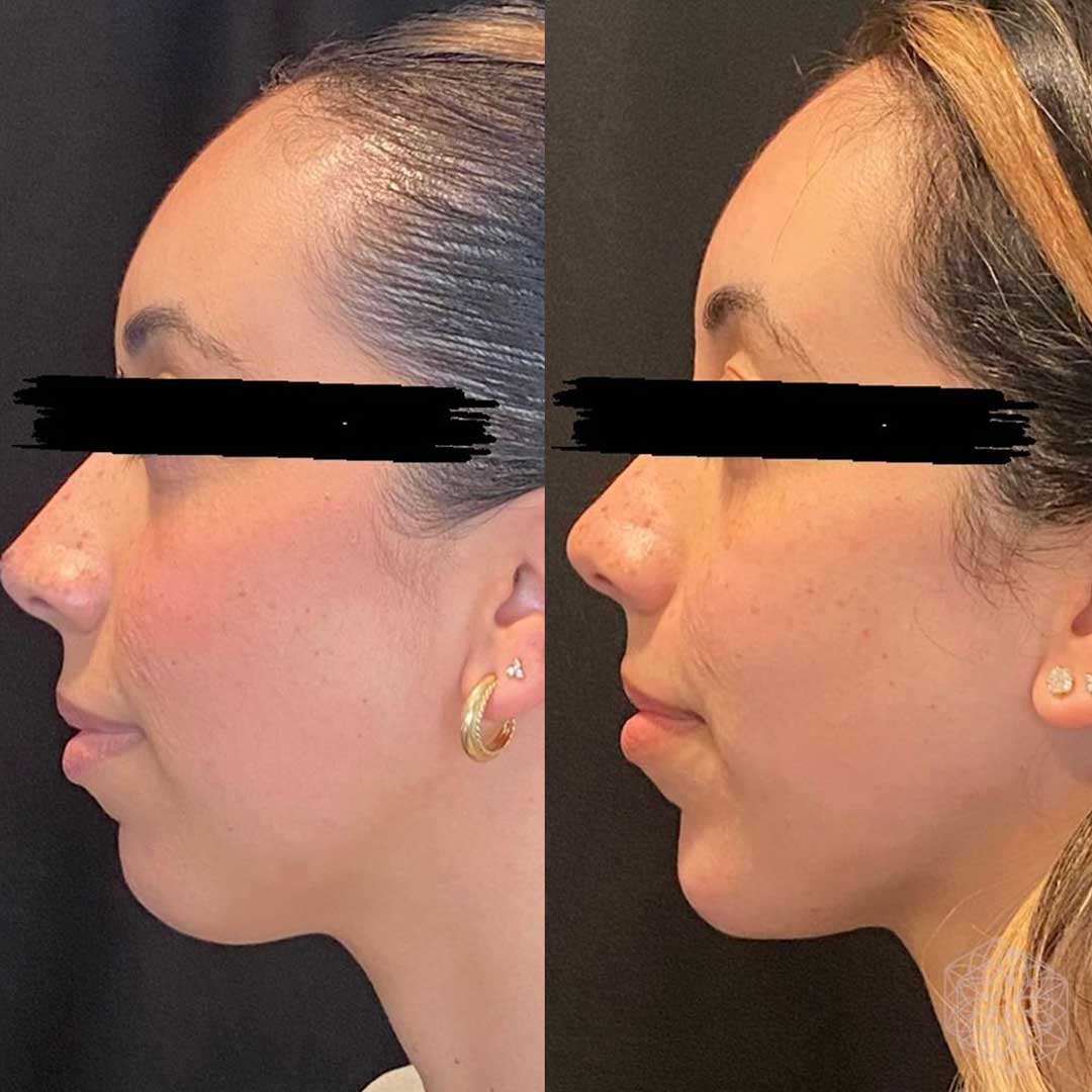 Woman with enhanced chin
