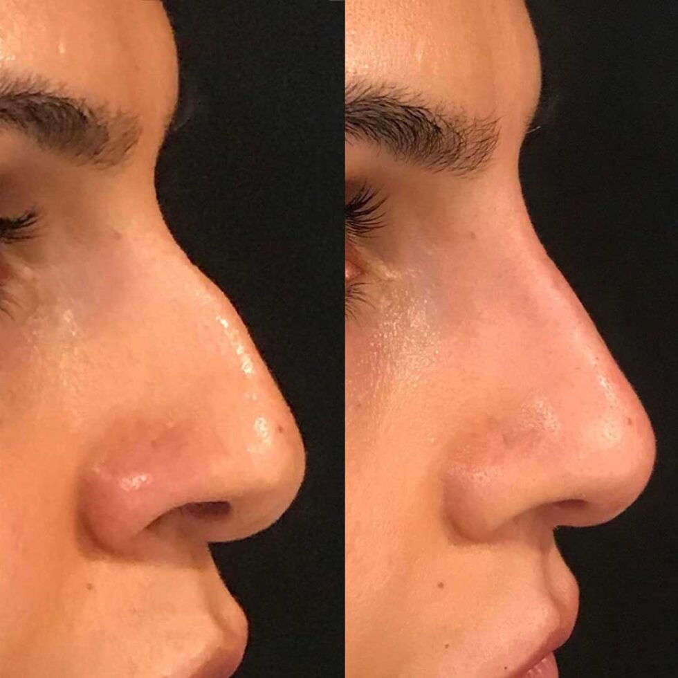 Non-Surgical Rhinoplasty - Clarity Medical Aesthetics