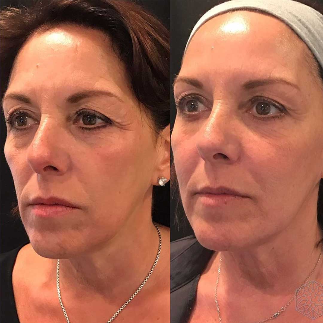 sculptra before and after