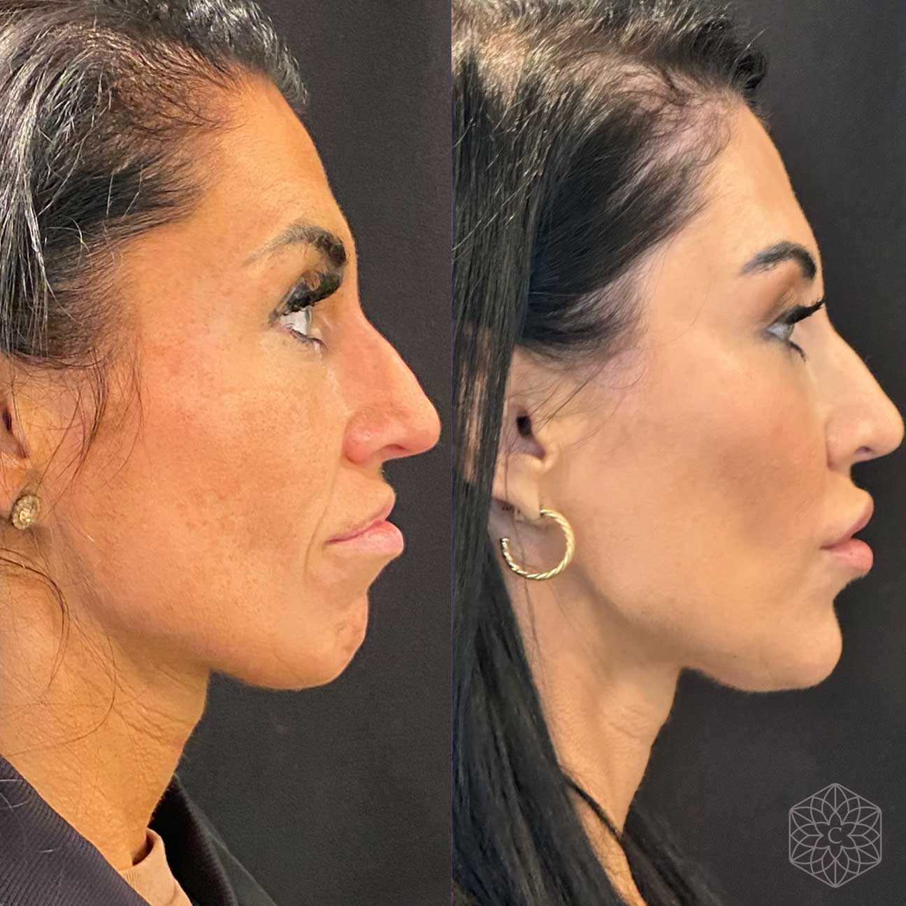 Achieve a more balanced face with expertly placed fillers