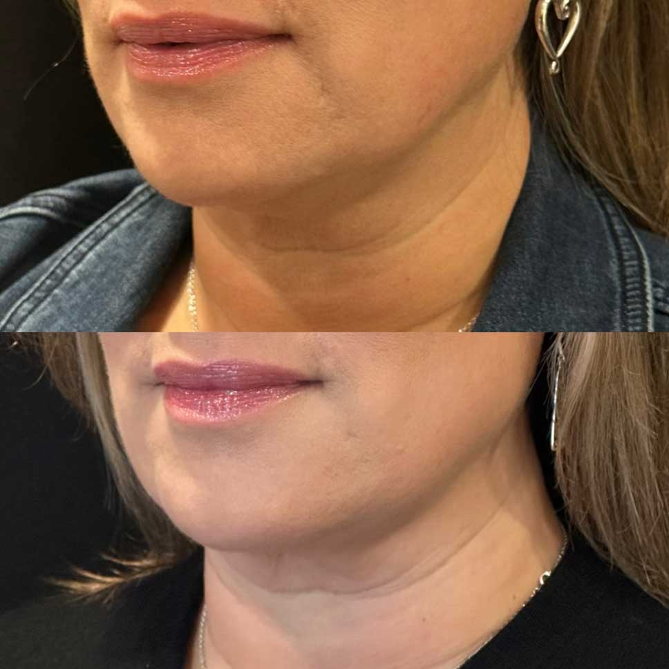 Reduce your double chin with Kybella