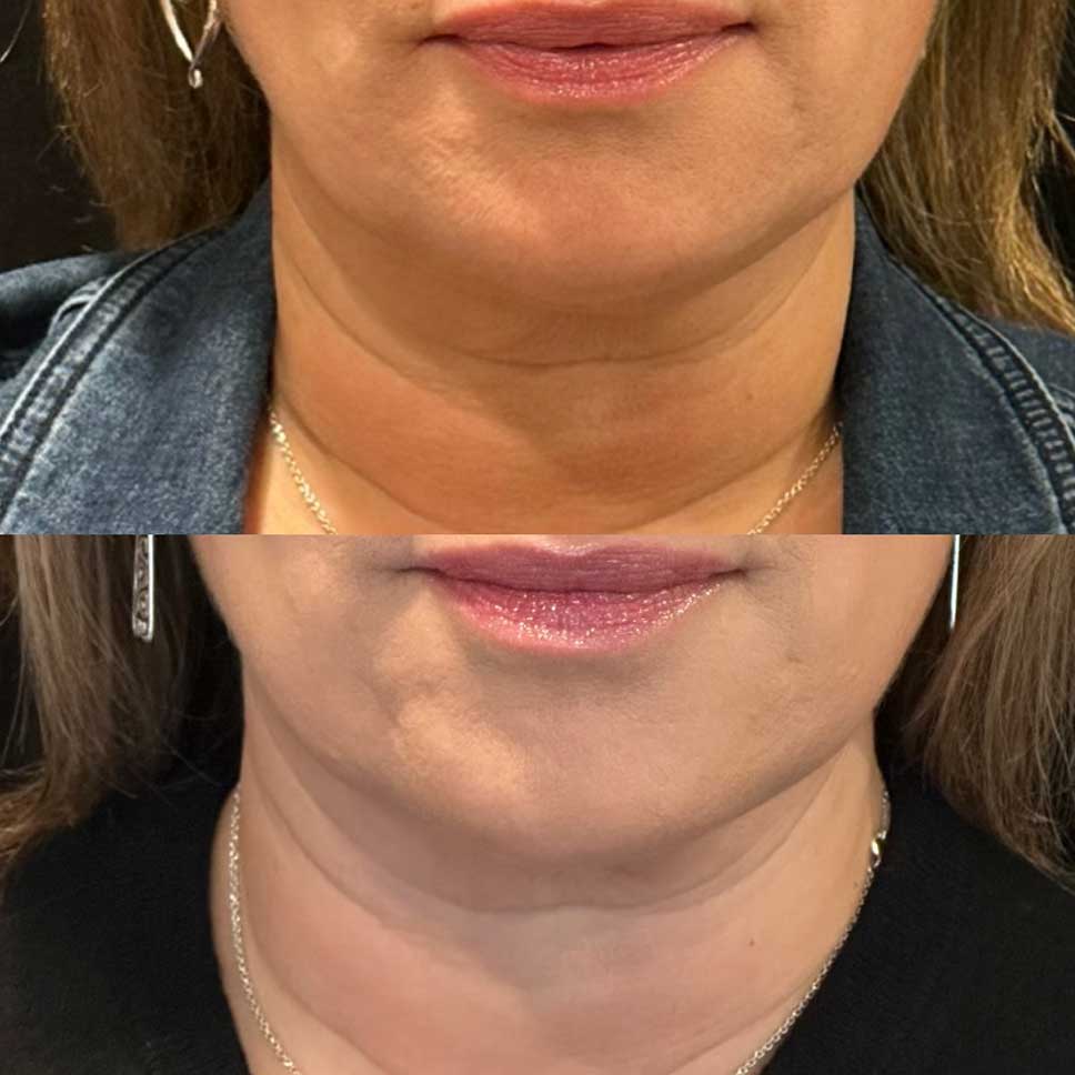 Reduce your double chin with Kybella