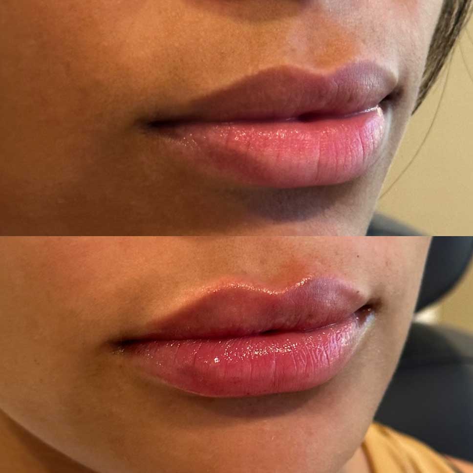 Lip shaping and detail with lip filler