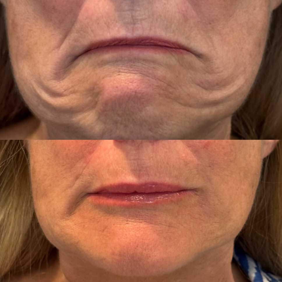 Reduce frown lines with botox