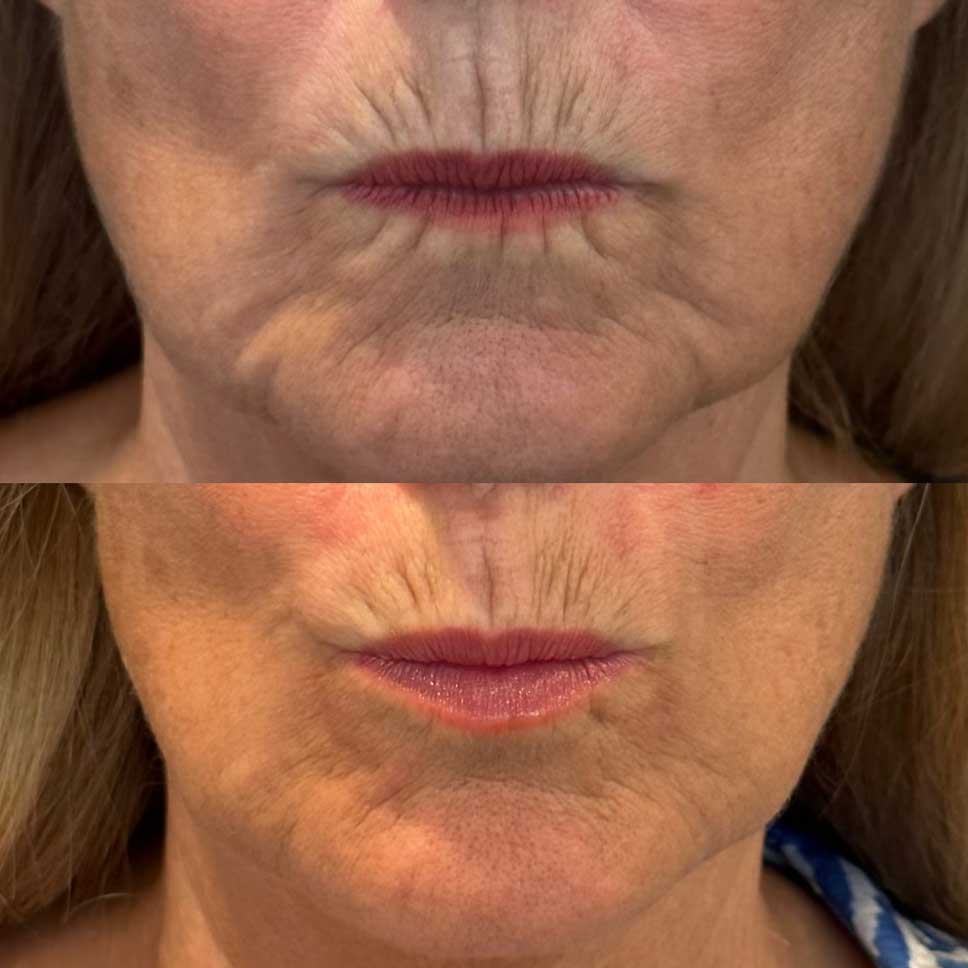 Ease vertical lip lines with botox