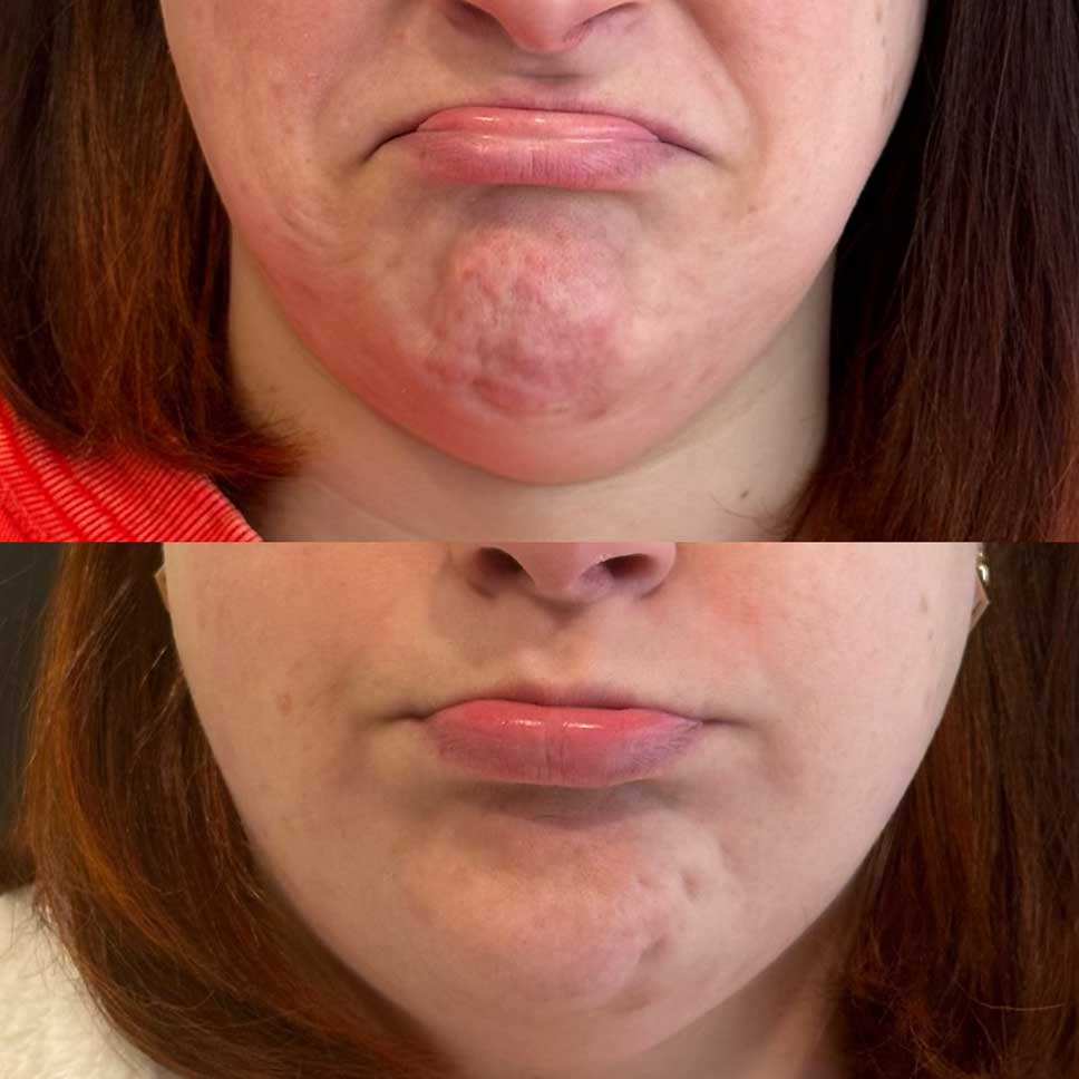 Reduce chin dimpling with botox