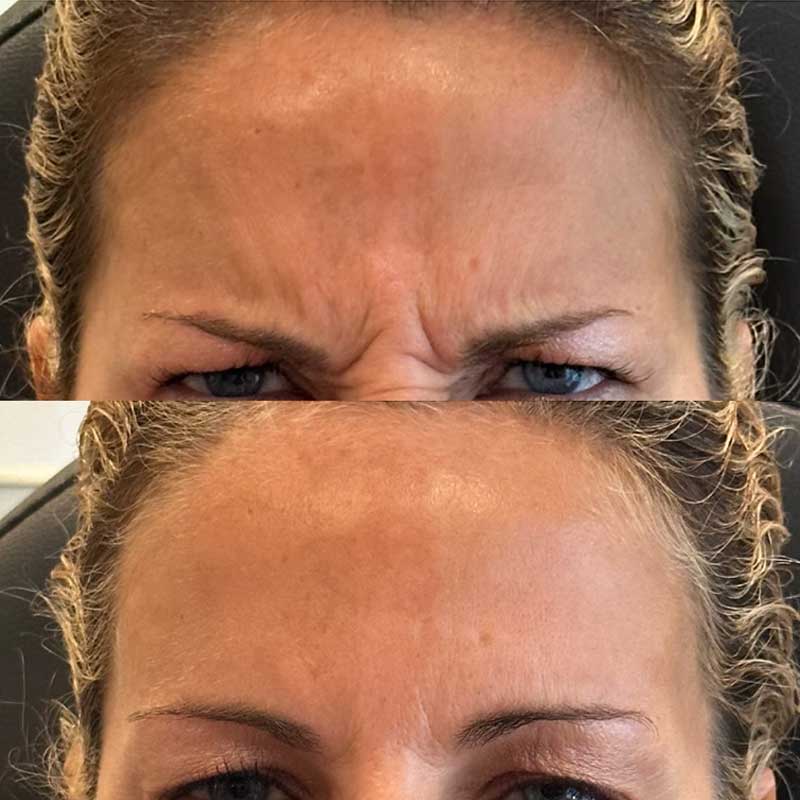 Get rid of 11's between the eyebrows with botox