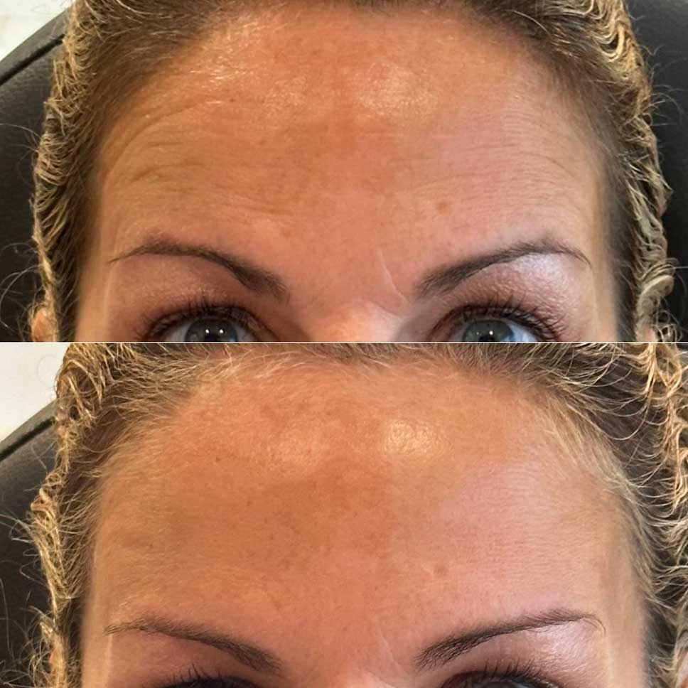 Smooth forehead lines with botox
