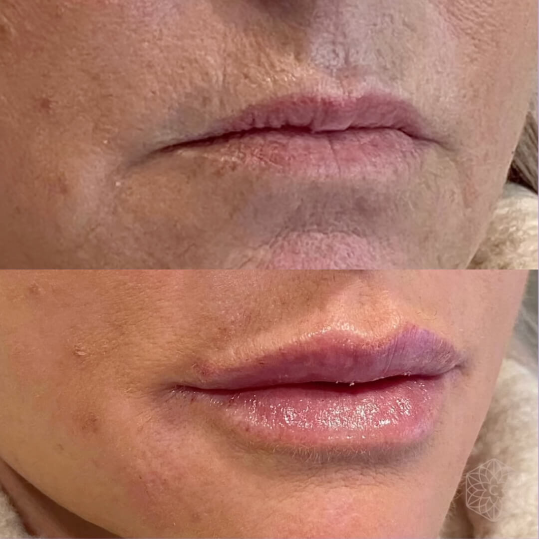 Lip enhancement by Clarity Medical Aesthetics using lip fillers